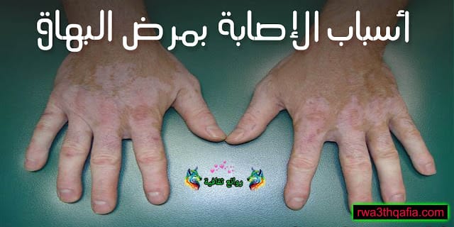 اسباب البهاق المفاجئ